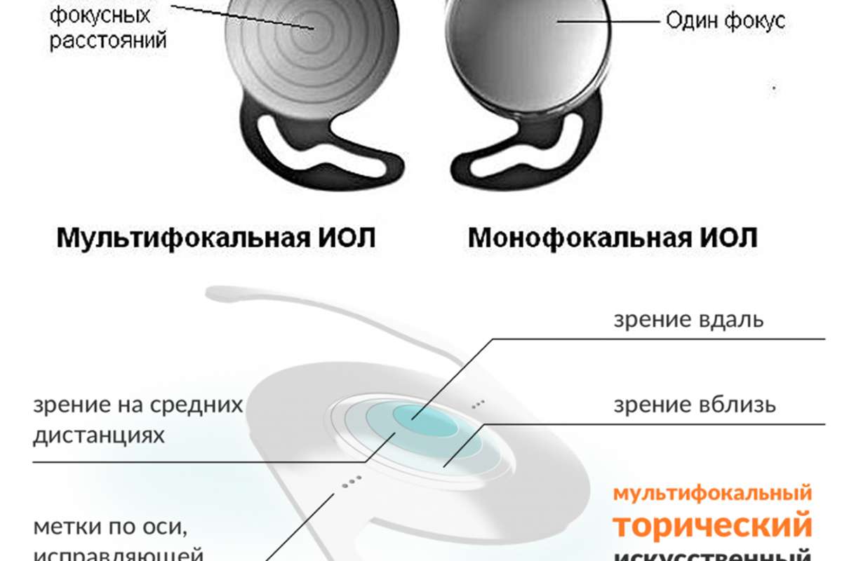 Фото работы по Интраокулярные линзы