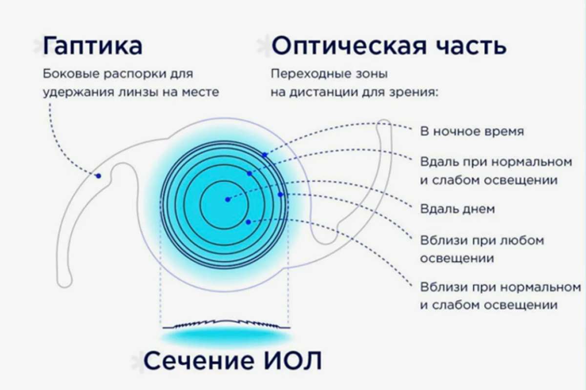 Фото работы по Интраокулярные линзы